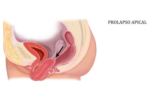 prolapso